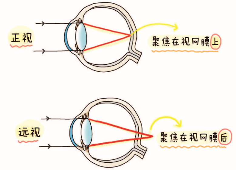 河南优尔视：近视的形成和假性近视